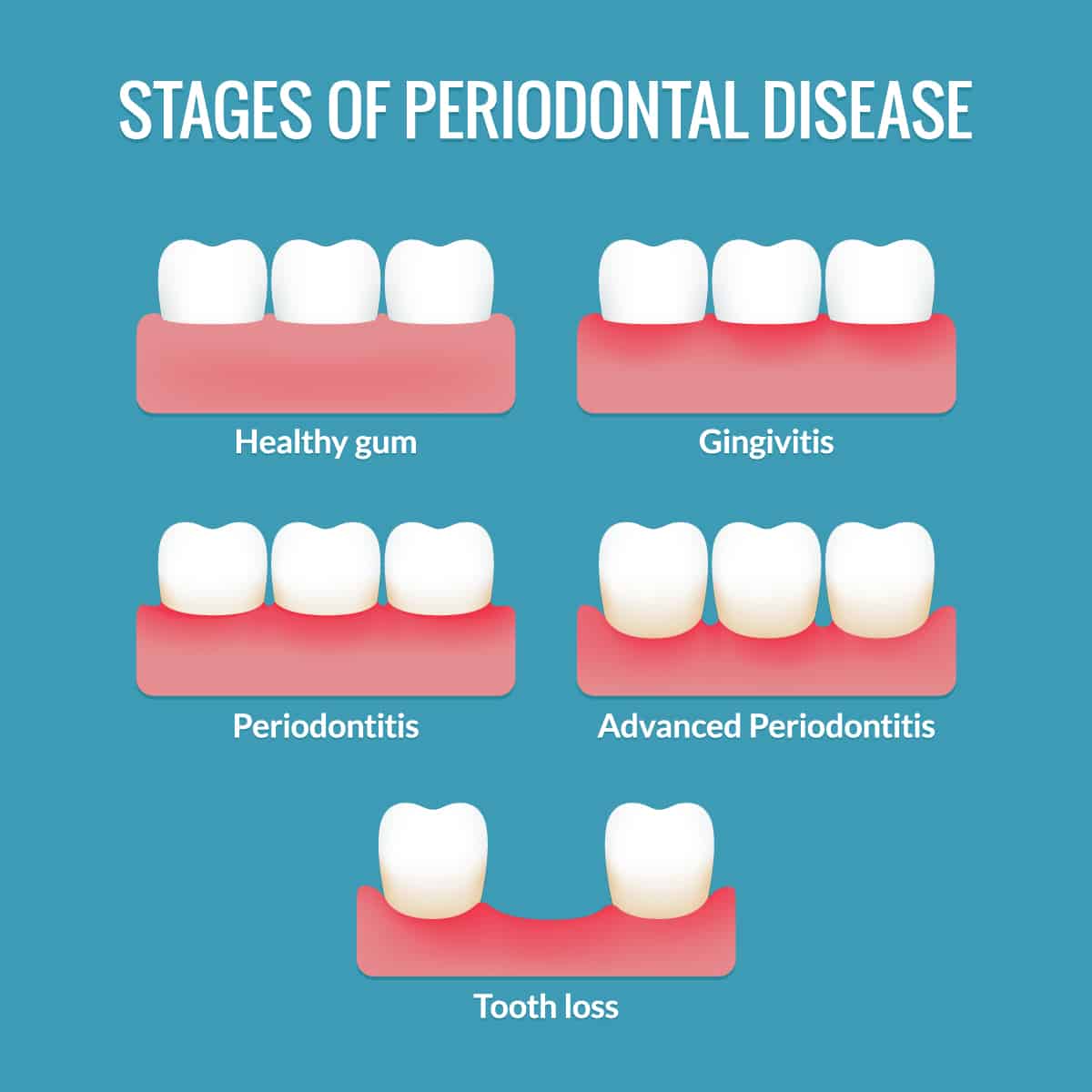 Periodontics - Beachside Dental Group