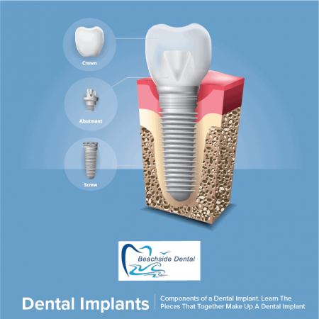 dental-implants-huntington-beach-beachside-dentistry